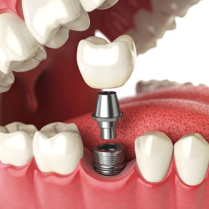 Mini Implants - Dental Services