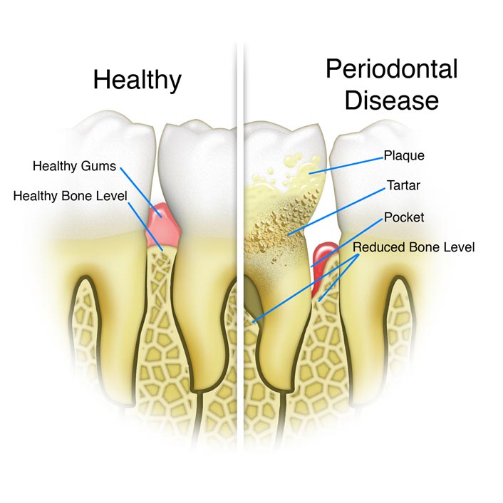 Periodontal Therapy - Dental Services